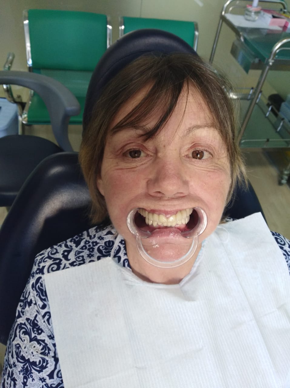 Отзыв о протезировании зубов в Китае после
